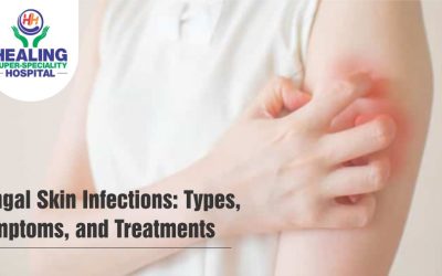 best treatment for fungal infection in Chandigarh