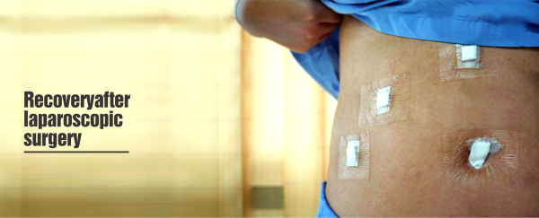 Laparoscopic surgery