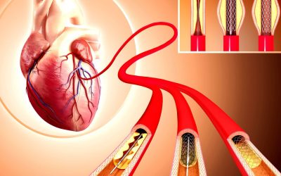 Healing Hospital Chandigarh Heart Stenting Surgery Cost in Chandigarh