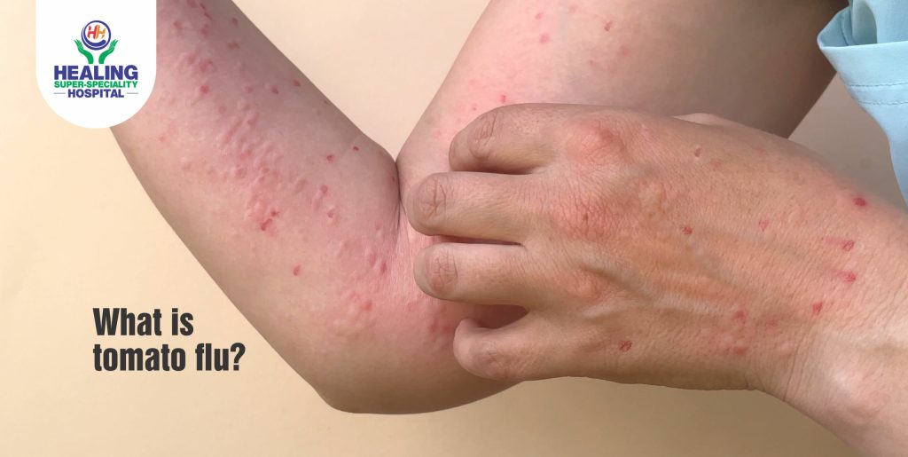 Tomato Flu Healing Hospital Chandigarh