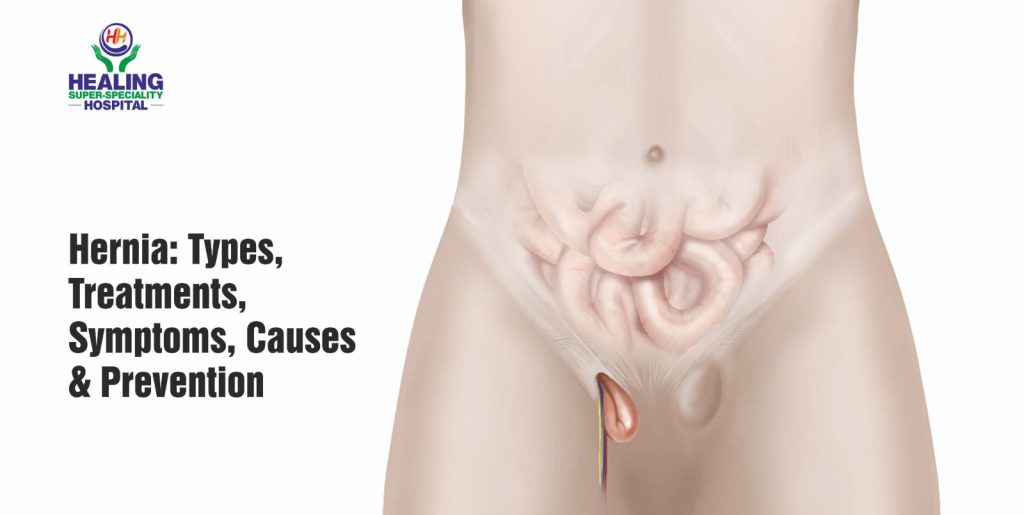 Hernia Treatment In Chandigarh