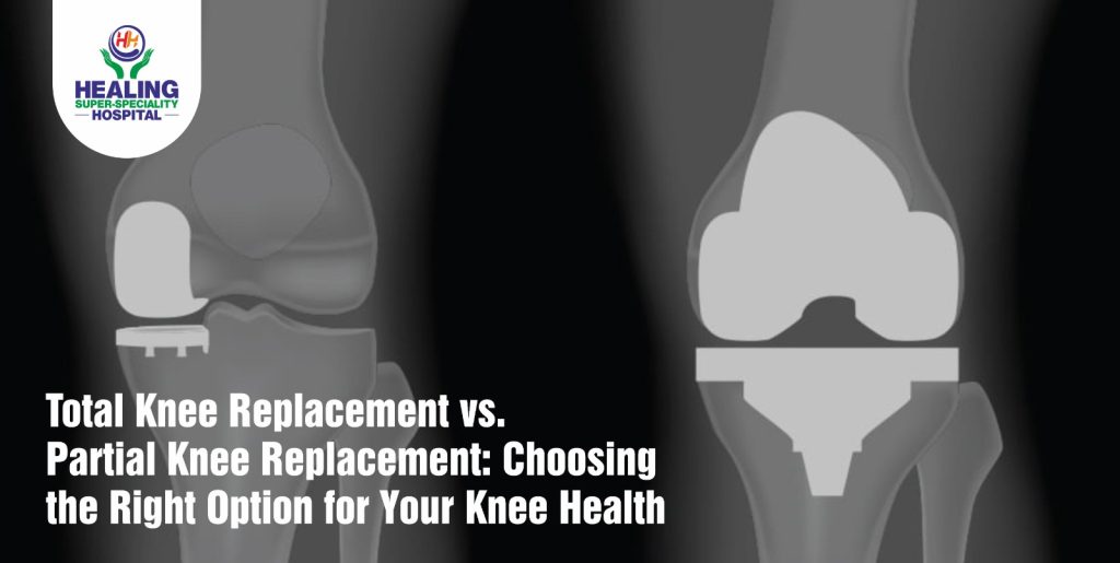 Total Knee Replacement in Chandigarh
