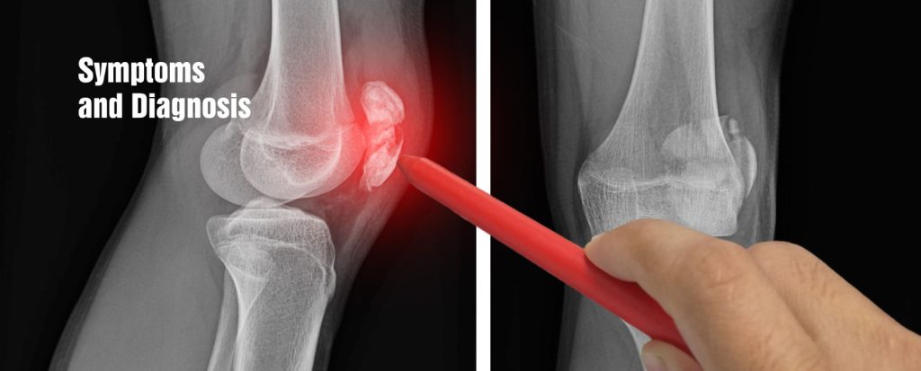 Best Knee Replacement Doctor in Chandigarh